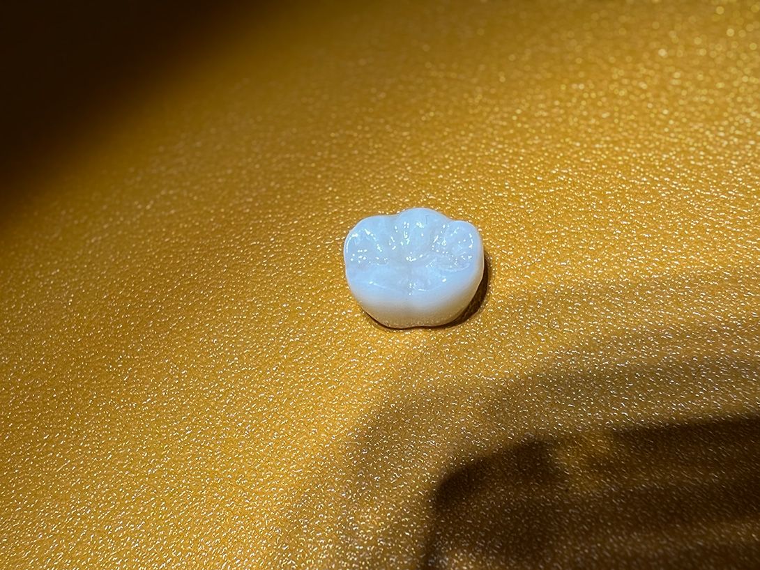 セラミック歯科治療｜牛込柳町・牛込歯科