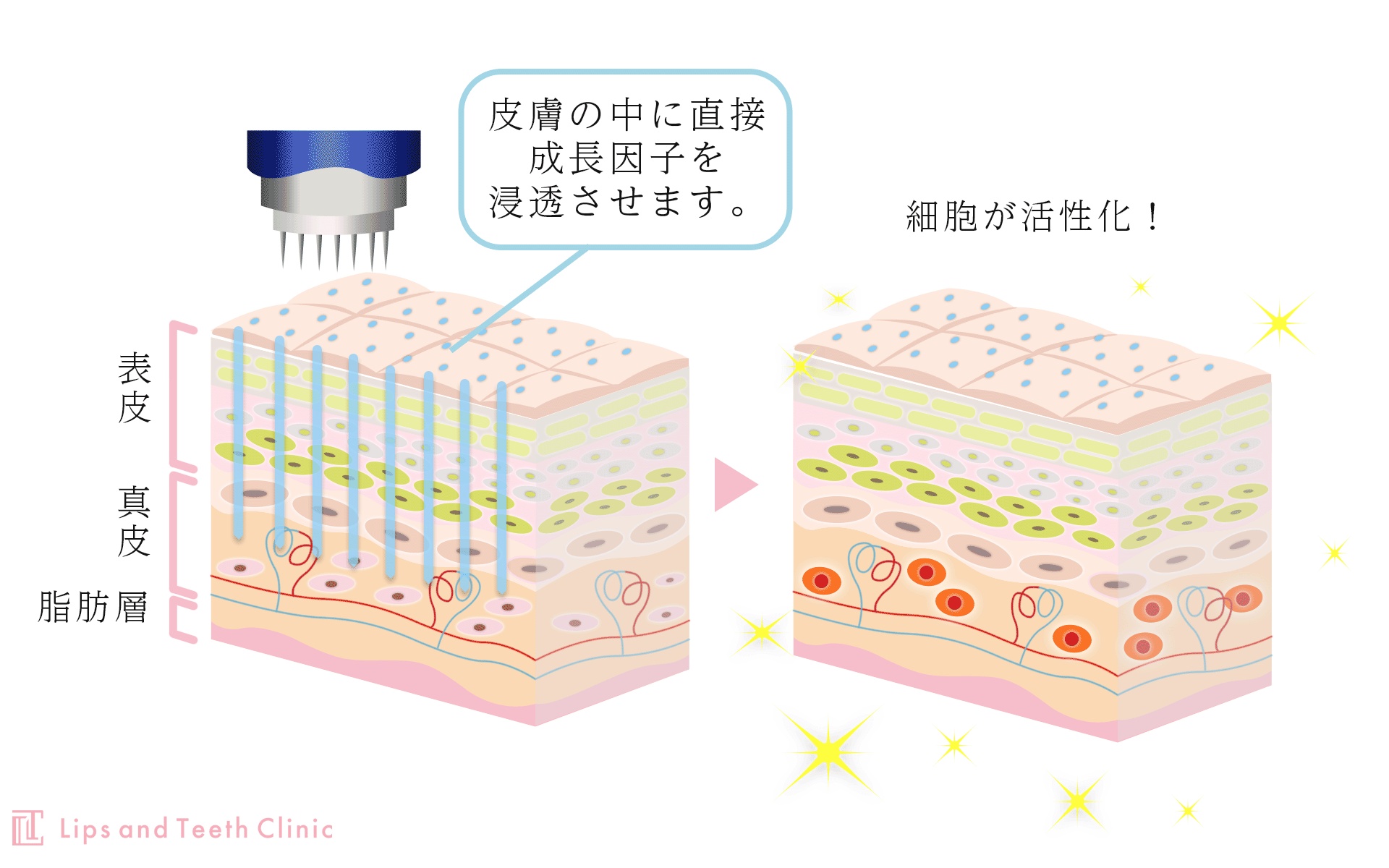 ダーマペン４　仕組み・LipsandTeethDentalClinic牛込歯科　審美