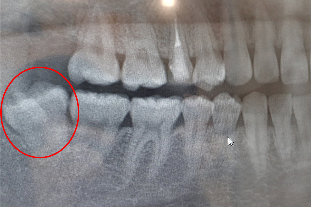 親知らずのトラブル